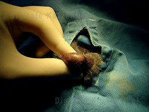 Bild 3. Fixation des Hodens vor Hautschnitt