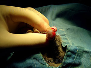 Bild 4. Hodenhüllen eröffnet (Offene Kastration)